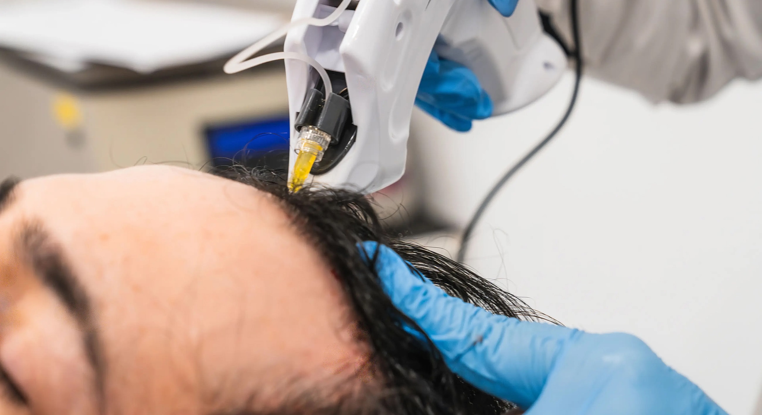 Hair treatment procedure using advanced technology.